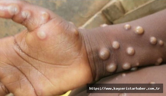 Maymun Çiçeği Hastalığı (monkeypox) Hızla Yayılıyor: Hastalanana Tecrit Kararı Geliyor