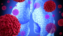 Akciğer Kanserinin Tedavisinde 3 Önemli Gelişme!